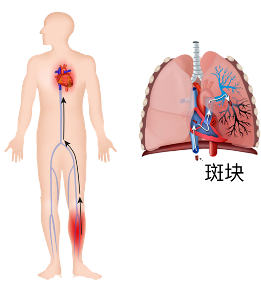 血栓是心梗、脑梗的元凶，很容易找上这些人