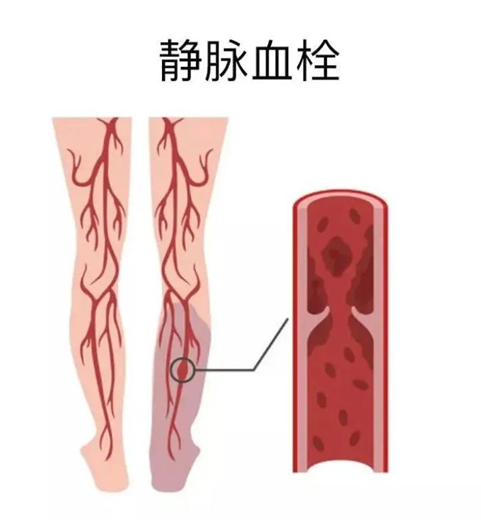 血栓是心梗、脑梗的元凶，很容易找上这些人