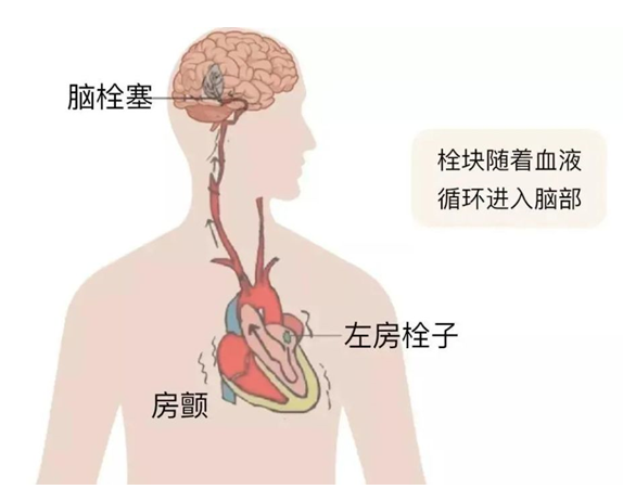 血栓是心梗、脑梗的元凶，很容易找上这些人