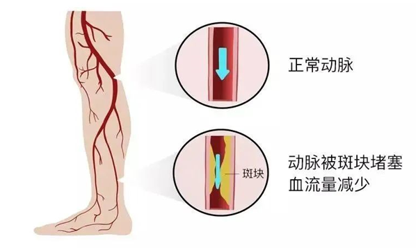 血栓是心梗、脑梗的元凶，很容易找上这些人