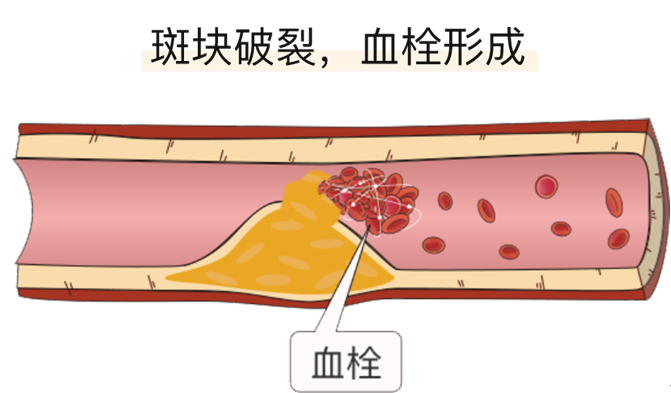 血栓是心梗、脑梗的元凶，很容易找上这些人